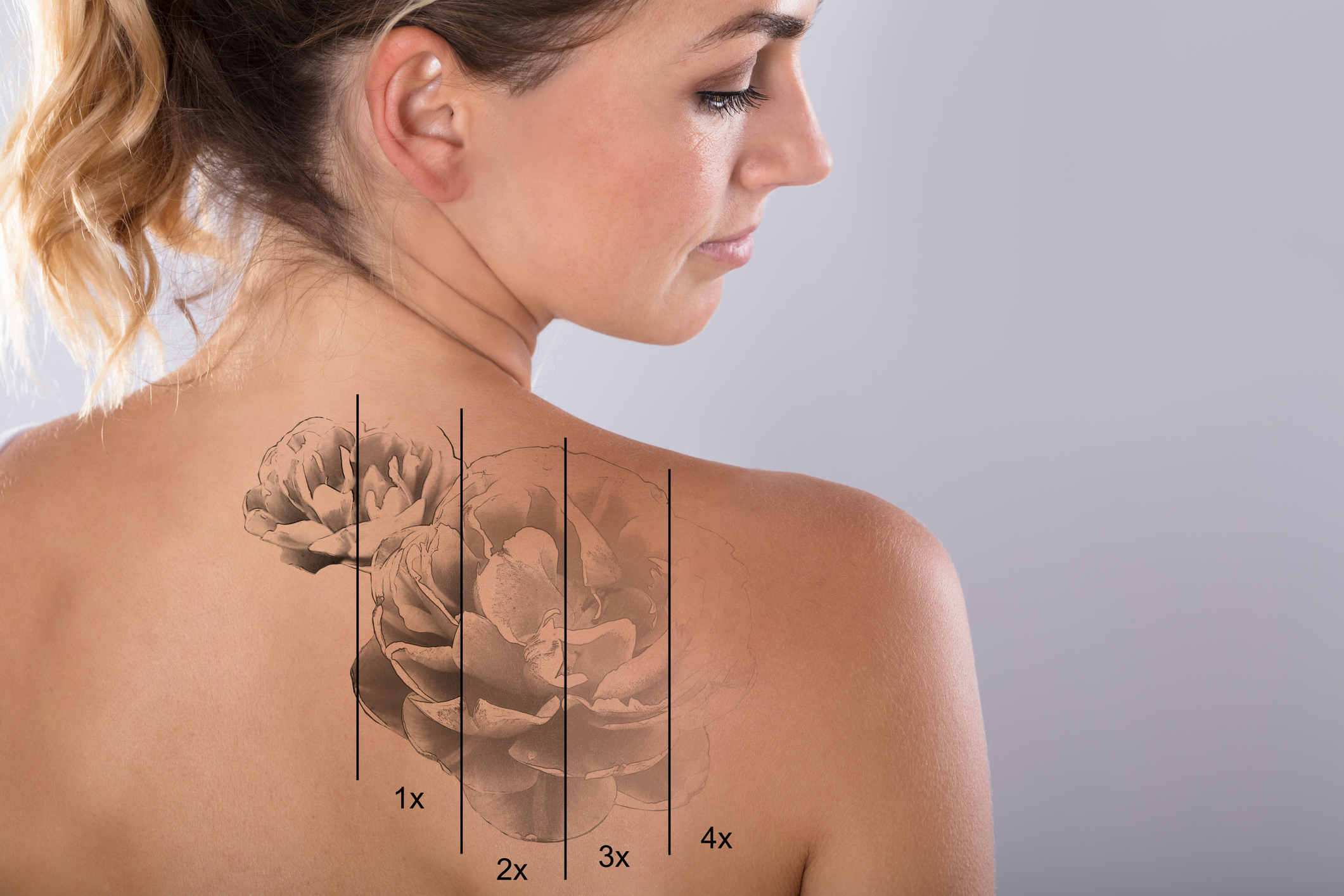 Laser tattoo removal on woman’s back