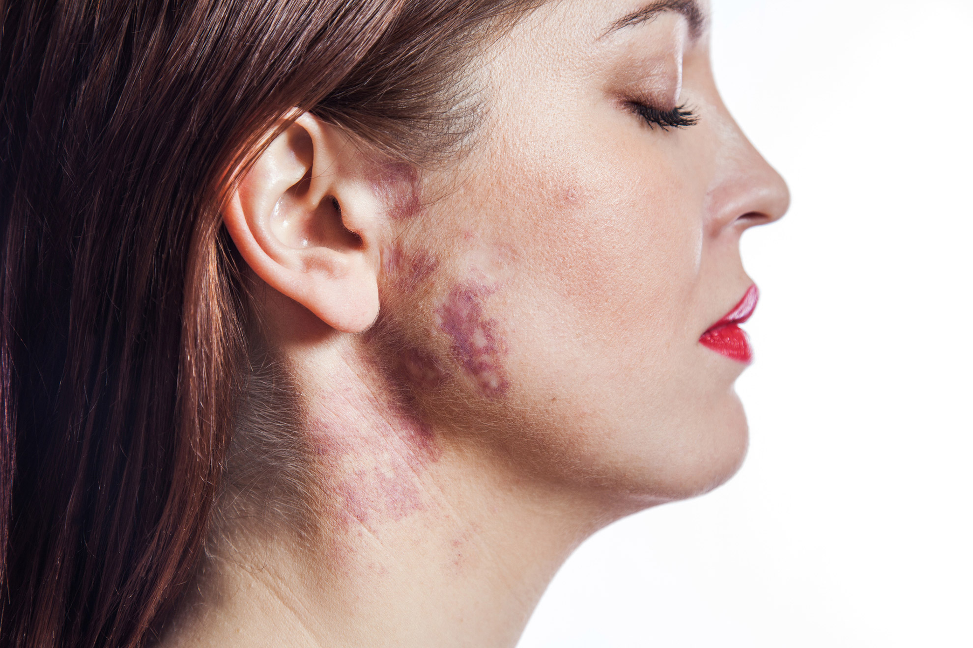 Woman-with-port-wine-stain-on-her-face-and-neck